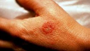 Aşırı kolonya ve dezenfektan kullanımı egzamaya yol açıyor