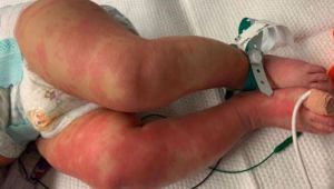 Çocuklar arasında yayılıyor diye uyarı yapılmıştı! İşte coronayla birlikte beliren diğer hastalık