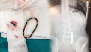 Aileler dikkat! Karın ağrısıyla hastaneye giden çocuğun midesinden 42 adet...