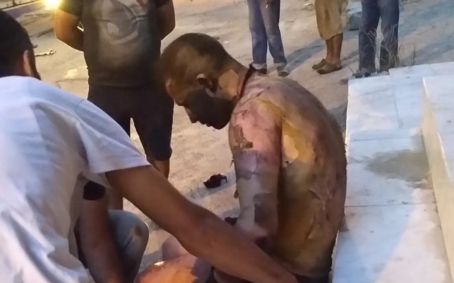 Üzerine tiner dökülerek yakıldığı ileri sürülen kişi yaşam mücadelesini kaybetti