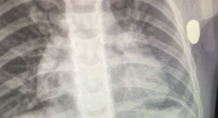 Salıncakta göğsüne 'yorgun mermi' isabet eden Berkin ağır yaralandı