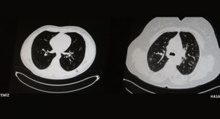 Kovid pozitif iki gencin aşısız ve aşılı tomografileri görüntülendi