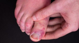 Uzmanlardan 'Covid parmağı sendromu' uyarısı