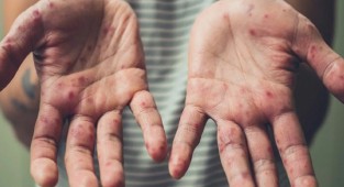 DSÖ'den kızamık uyarısı!