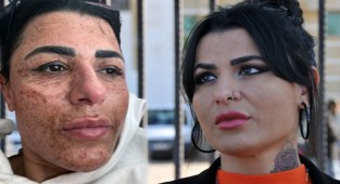 Yüz yakan lazer davası açıklandı 