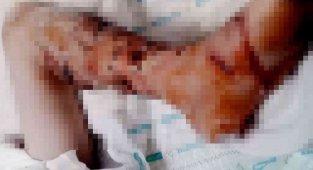 4 yıl önce pitbull saldırısına uğrayan çocuk, psikolojik tedavi alıyor