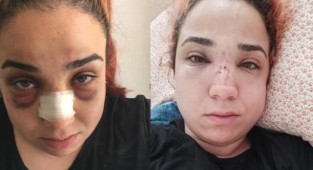 İzmir'de patron cep telefonuyla konuştuğu için kadın işçinin burnunu kırdı