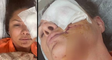 Köpek saldırısına uğrayan şarkıcı Tuğba Altıntop’un yüzüne dikiş atıldı