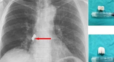 Diş tedavisi gören bir kişinin soluk borusuna 2 implant kaçtı