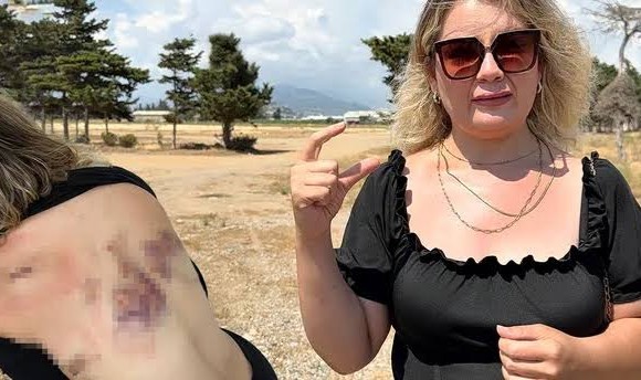 7 Kez Uzaklaştırma Kararı Aldırdı! Eski Sevgilisinin Bıçaklı Saldırısına Uğradı: 'Bıçak Kırılmasaydı Yaşama Şansım Yoktu'